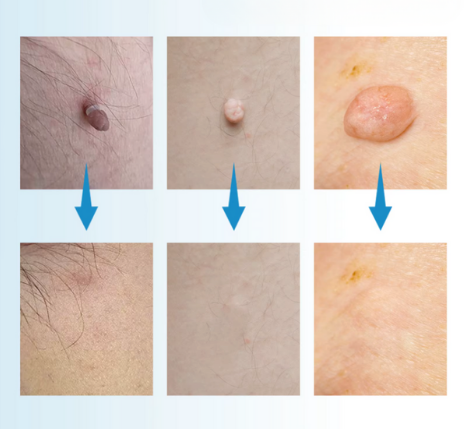 Kit Eliminator de Papiloame şi Imperfecțiuni ale pielii